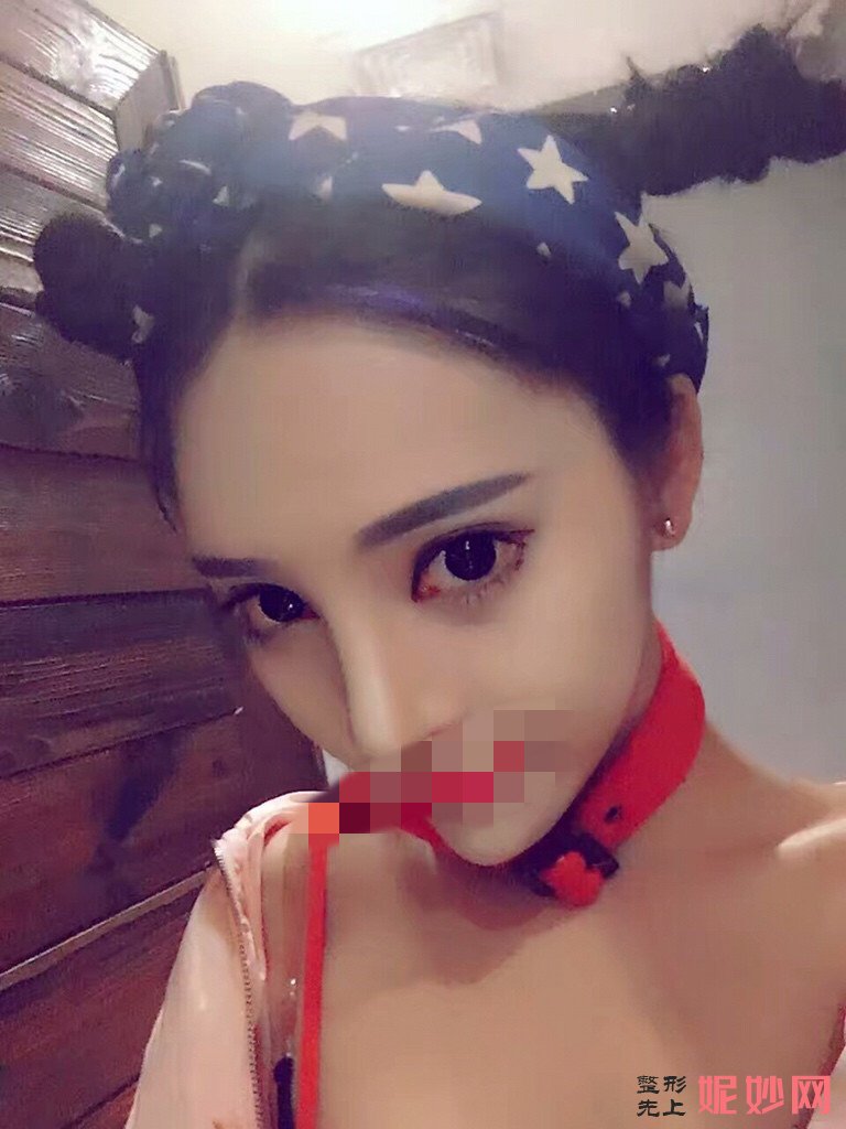 北大崔永言做鼻翼缩小怎么样？附鼻翼缩小前后效果图+2021较新价格表