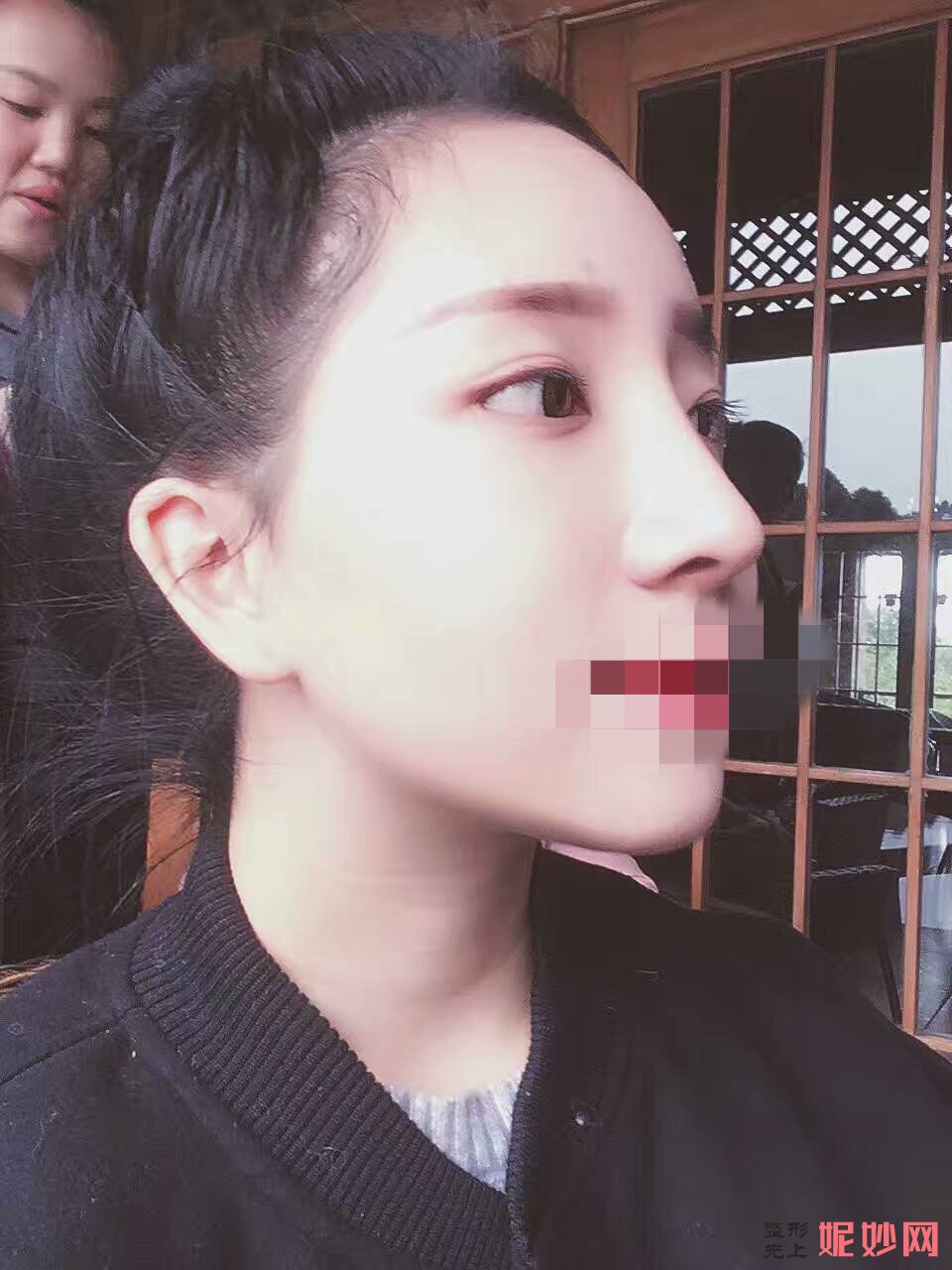 深圳北大李天石鼻综合案例？让我拥有了好看的鼻子了！