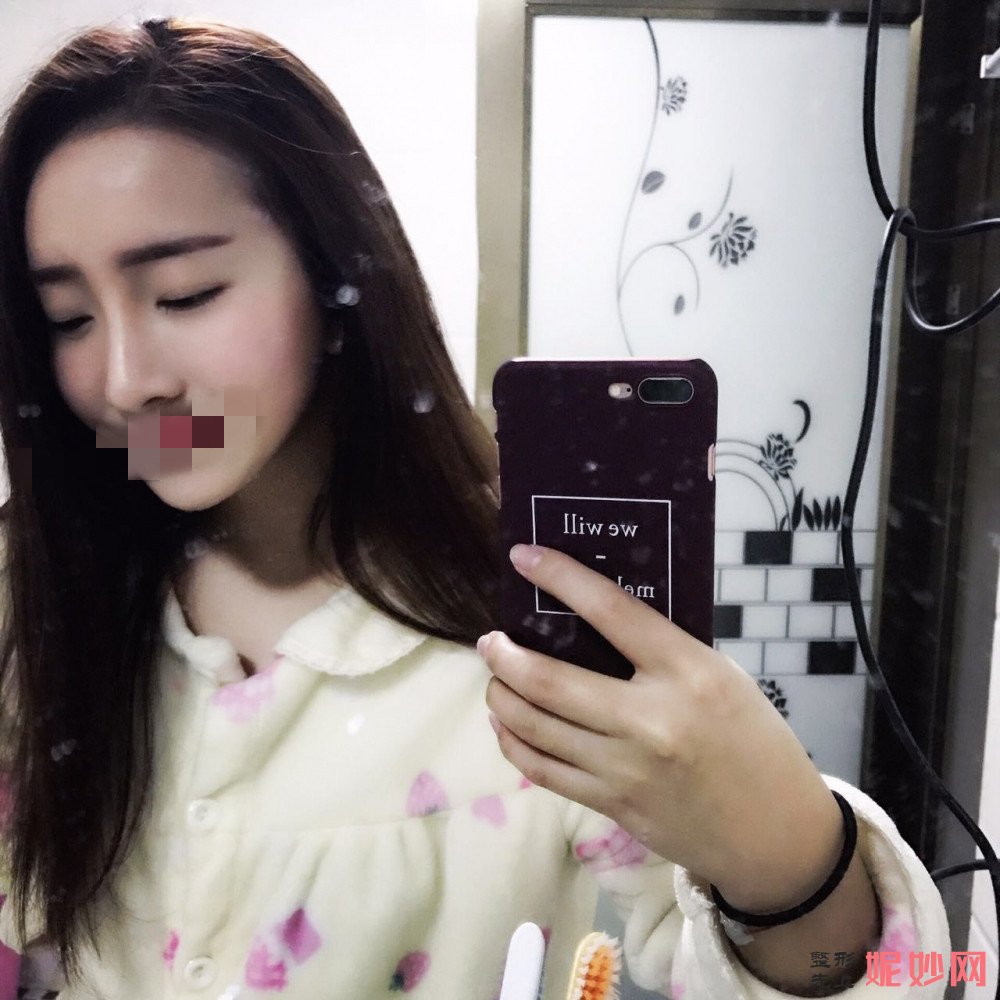 深圳北大李天石鼻综合案例？让我拥有了好看的鼻子了！