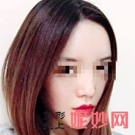 深圳北大医院李天石垫下巴案例？我变得非常好看呢！