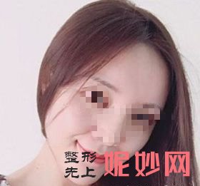 深圳北大医院李天石垫下巴案例？我变得非常好看呢！