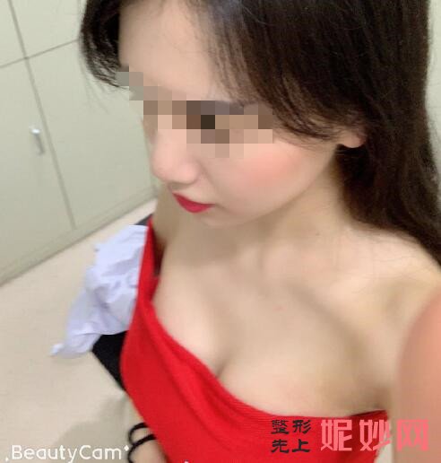 深圳北大李天石做胸怎么样？让我有了性感的身材！