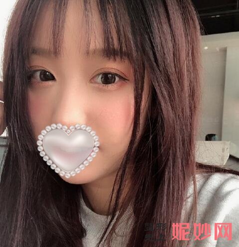 深圳北大医院李天石双眼皮怎么样？术后效果太好看了！