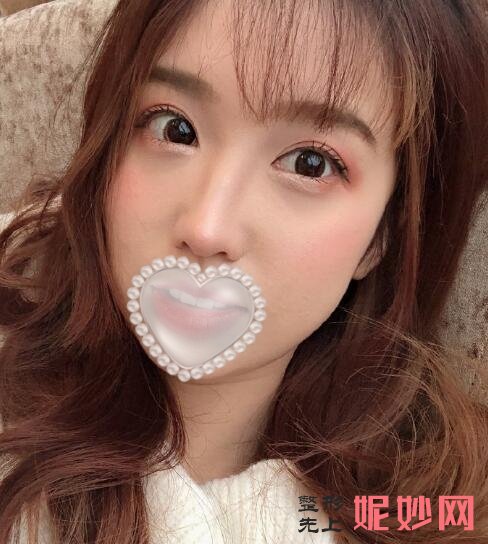 深圳北大医院李天石双眼皮怎么样？术后效果太好看了！