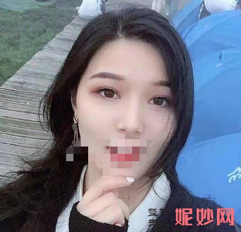 深圳北大李天石外切眼袋怎么样？让我去掉了眼袋！术后太好看了！