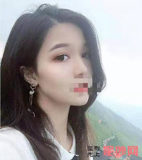 深圳北大李天石外切眼袋怎么样？让我去掉了眼袋！术后太好看了！