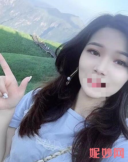 深圳北大李天石外切眼袋怎么样？让我去掉了眼袋！术后太好看了！
