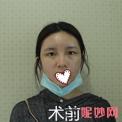 深圳北大李天石双眼皮案例？让我的眼睛有了双眼皮！