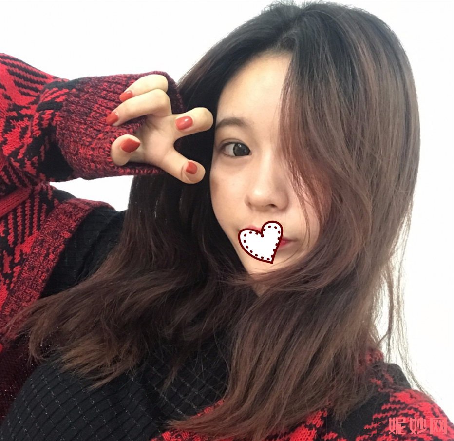 深圳北大李天石双眼皮案例？让我的眼睛有了双眼皮！