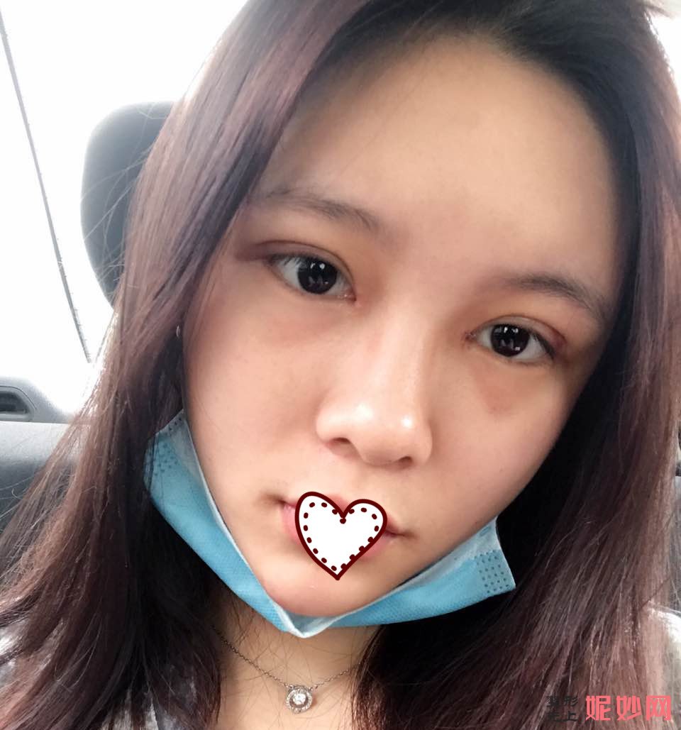 深圳北大李天石双眼皮案例？让我的眼睛有了双眼皮！