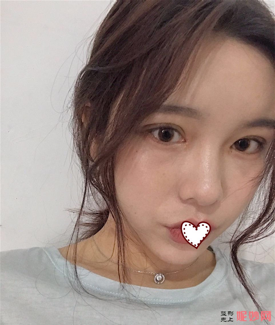 深圳北大李天石双眼皮案例？让我的眼睛有了双眼皮！