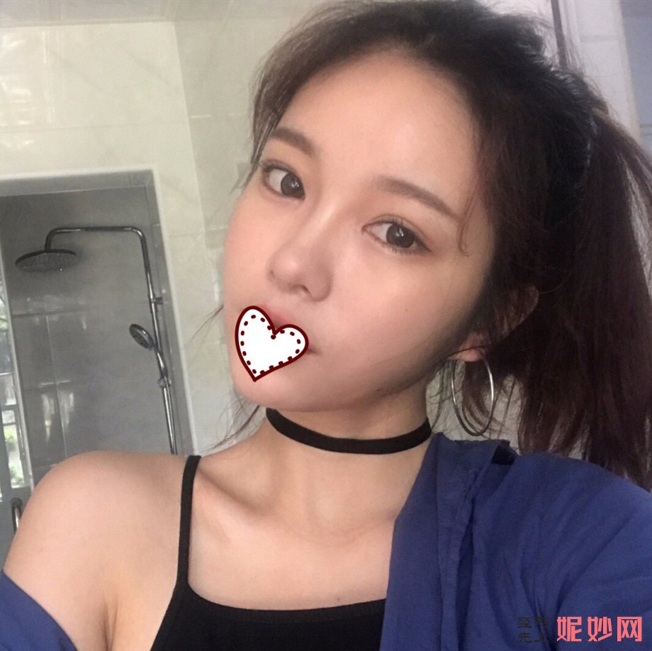 深圳北大李天石双眼皮案例？让我的眼睛有了双眼皮！