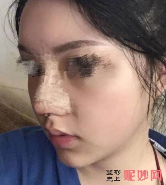 深圳北大何君君鼻综合怎么样？让我鼻子也让别人羡慕了！