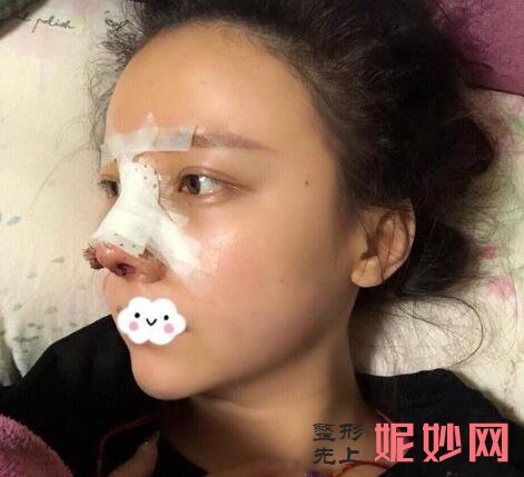 深圳北大何君君鼻子案例？让我的鼻子在术后好看了！