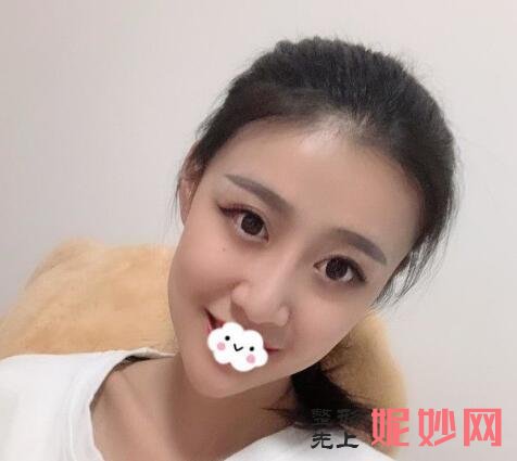 深圳北大何君君鼻子案例？让我的鼻子在术后好看了！