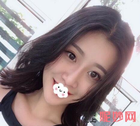 深圳北大何君君鼻子案例？让我的鼻子在术后好看了！