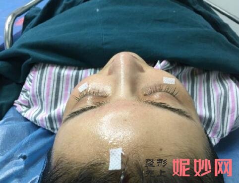 北大深圳何君君脂肪填充案例？让我的面部好看了！