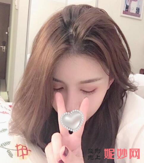 北大深圳何君君脂肪填充案例？让我的面部好看了！
