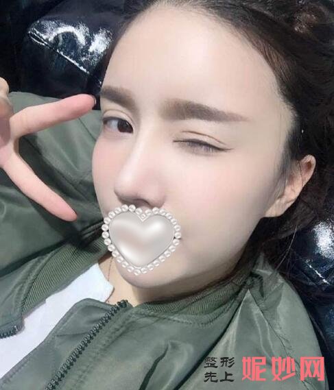 北大深圳何君君脂肪填充案例？让我的面部好看了！
