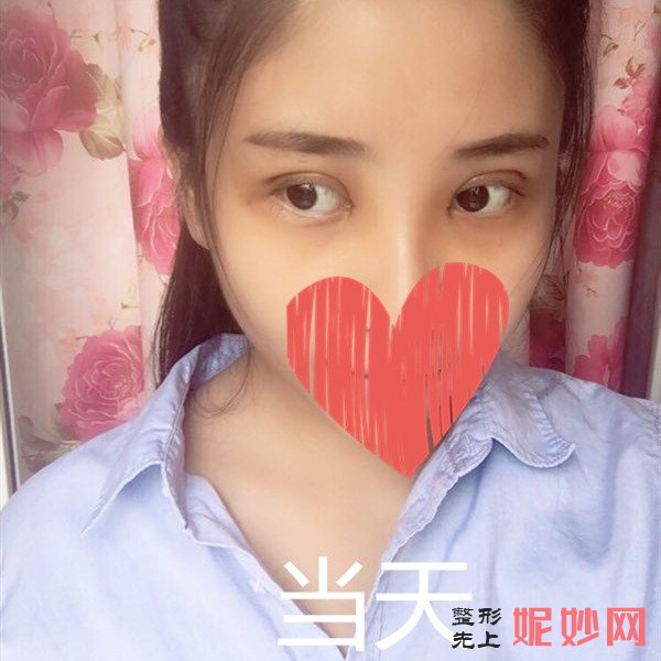 深圳北大何君君双眼皮怎么样？让我了好看的双眼皮！