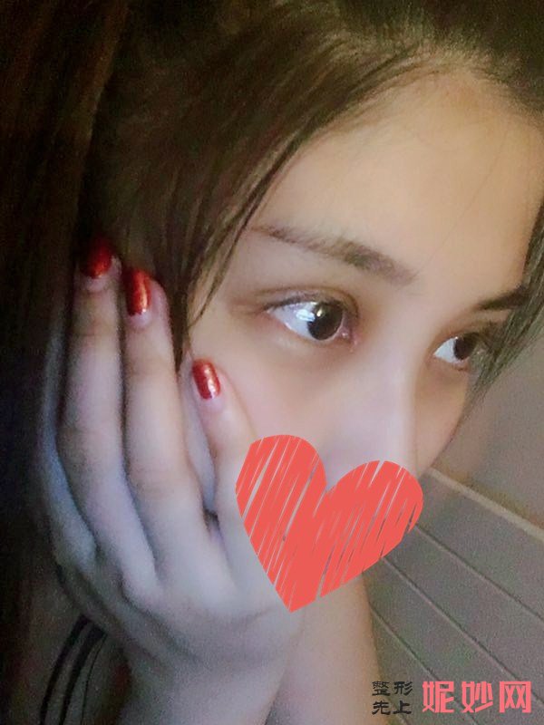 深圳北大何君君双眼皮怎么样？让我了好看的双眼皮！