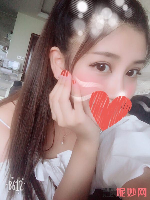 深圳北大何君君双眼皮怎么样？让我了好看的双眼皮！