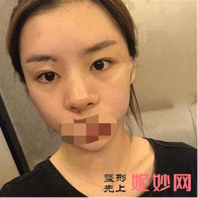 我在北京做的膨体隆鼻,分享术后一月效果