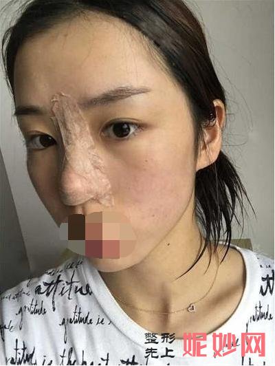 我在北京做的膨体隆鼻,分享术后一月效果