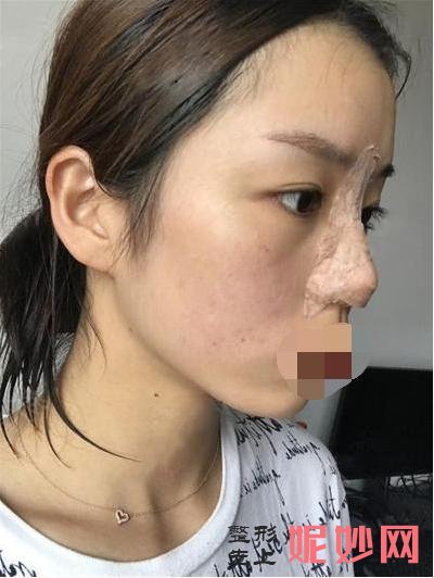 我在北京做的膨体隆鼻,分享术后一月效果