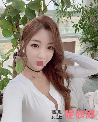 我在北京做的膨体隆鼻,分享术后一月效果