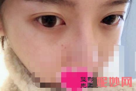 长沙做双眼皮较出名的专家排名：田芳斌、龙剑虹、张姣姣、解灿、杨将哪个眼部整形技术好？附案例价格表！