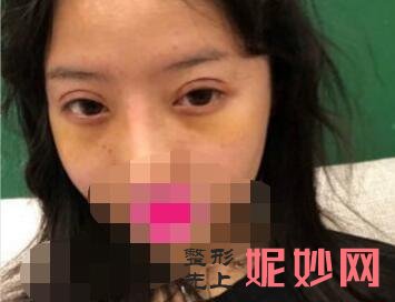 长沙做双眼皮较出名的专家排名：田芳斌、龙剑虹、张姣姣、解灿、杨将哪个眼部整形技术好？附案例价格表！