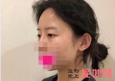 长沙做双眼皮较出名的专家排名：田芳斌、龙剑虹、张姣姣、解灿、杨将哪个眼部整形技术好？附案例价格表！