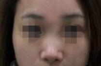 合肥艺星整形医院玻尿酸隆鼻怎么样,多久做一次？内附案例