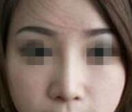合肥艺星整形医院玻尿酸隆鼻怎么样,多久做一次？内附案例