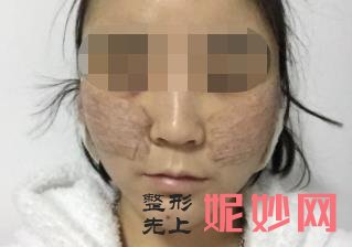 北京八大处颧骨内推怎么样？附八大处磨骨案例一览和价格表！