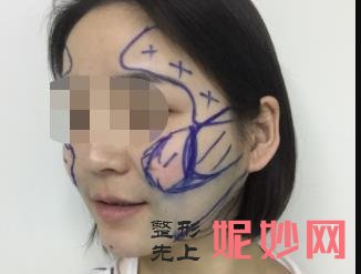 北京八大处颧骨内推怎么样？附八大处磨骨案例一览和价格表！