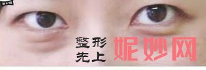 北京丽眼国际去眼袋机构(北京站店)口碑好不好？内含价格表以优秀案例