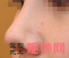 南京友谊林金德做鼻子怎么样？内附案例