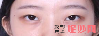 长沙眼综合哪个专家较好？眼综合价格如何？