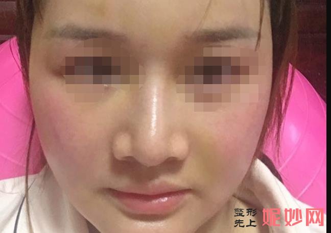 上海九院面部脂肪填充哪个专家好？附案例分析及价格表！