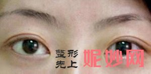 西安画美罗曼割双眼皮口碑好不好？内含价格表和案例分析