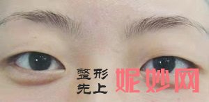 西安画美罗曼割双眼皮口碑好不好？内含价格表和案例分析