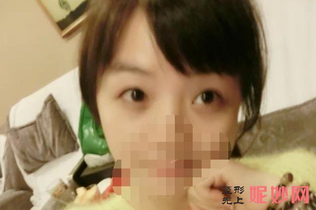 上海九院做上眼皮眼综合多少钱？附案例分析及价格表！