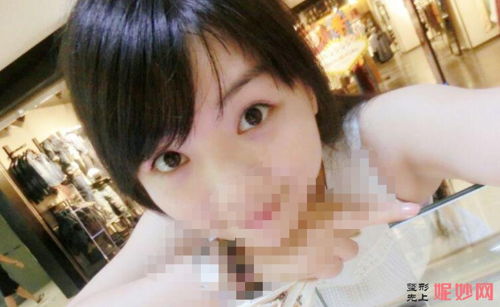 上海九院做上眼皮眼综合多少钱？附案例分析及价格表！