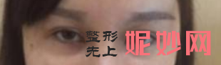 北京八大处做上睑下垂较好的专家是谁？附价格表