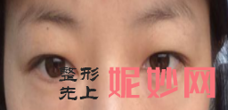 北京八大处做眼袋哪个大夫比较好？附案例分析和价格表