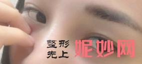 北京八大处王太玲做眼袋怎么样？附案例分析和价格表