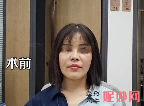 案例分析鼻综合王会勇和刘彦军哪个好？