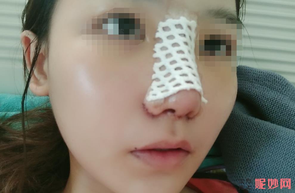 西安张曦和金磊哪个专家鼻综合做的较好？附案例介绍和价格表！